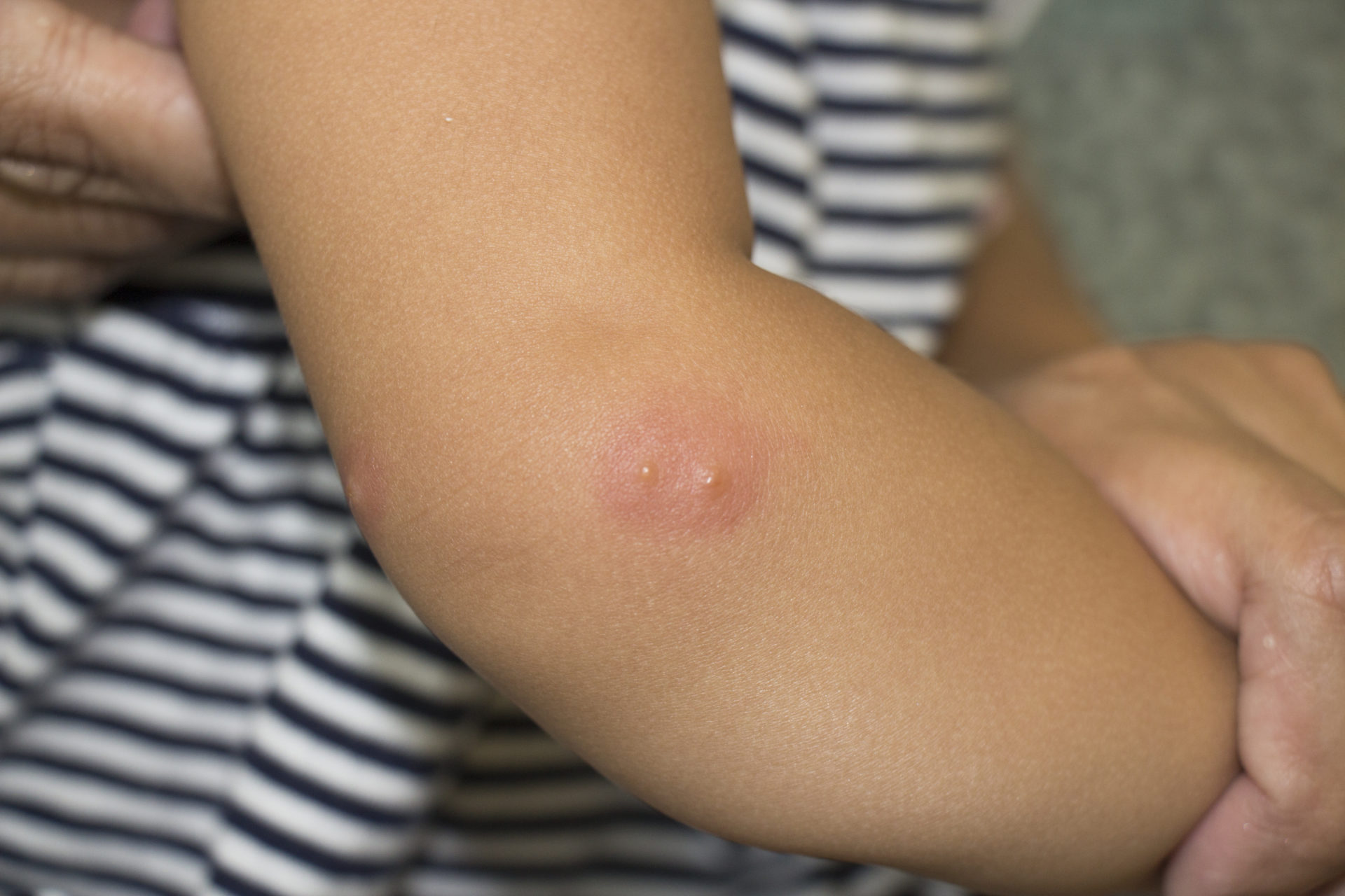 7 Ways to Naturally Soothe Summer Rashes, Bug Bites & Stings